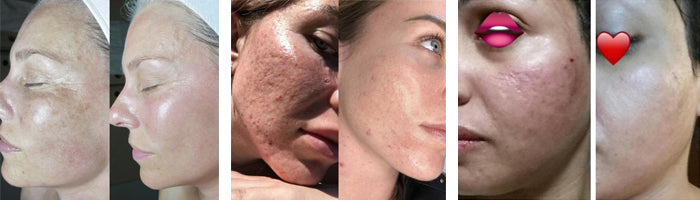 Otesaly skin rejuvenation before & after