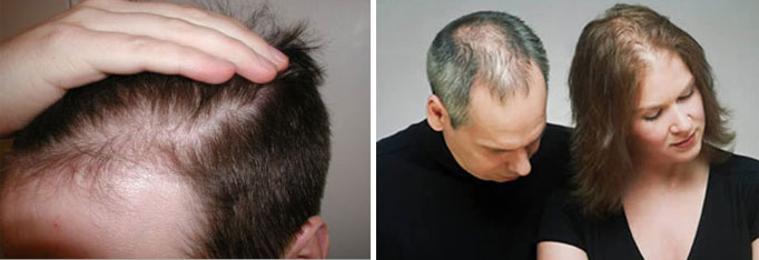 Otesaly Mesotherapy Solution for hair growth