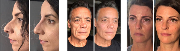 Otesaly Before & After