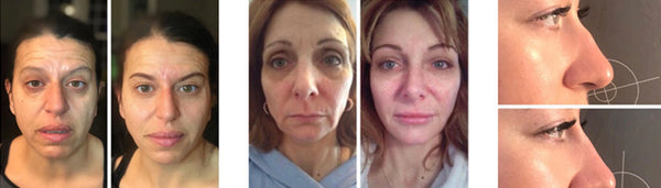 Otesaly Before & After