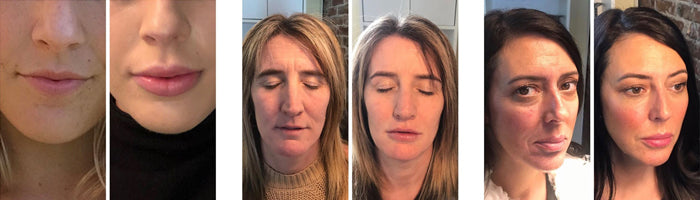 otesaly dermal filler before & after