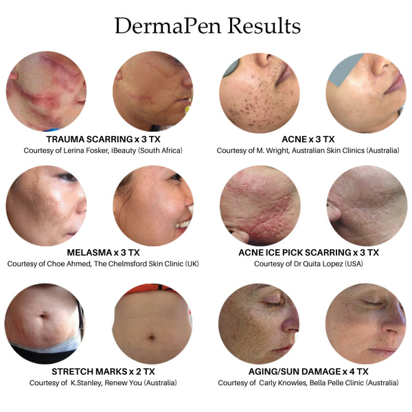 Derma Pen Results