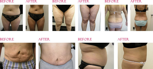 Otesaly Before & After for Lipolytic