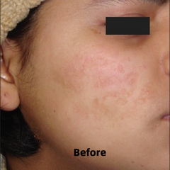 Before and After of Microneedling Treatment