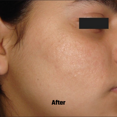 Before and After of Microneedling Treatment