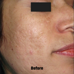 Before and After of Microneedling Treatment 
