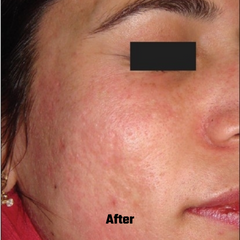 Before and After of Microneedling Treatment 