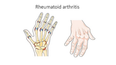 rheumatoid arthritis