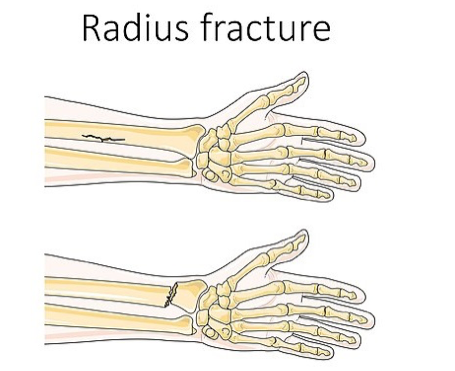 radius fracture of hands