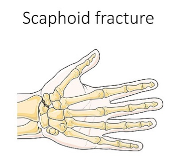 scaphoid fracture of hands