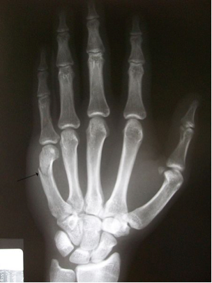 fracture of the 5th metacarpal