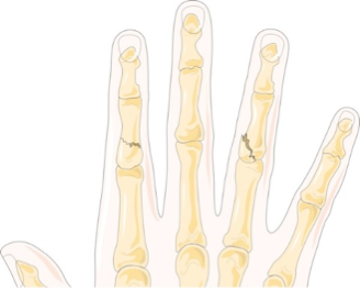 phalanges fracture