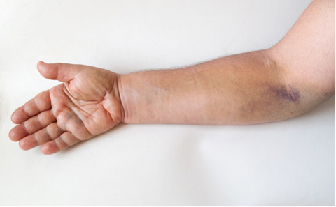 wrist sprain and strain
