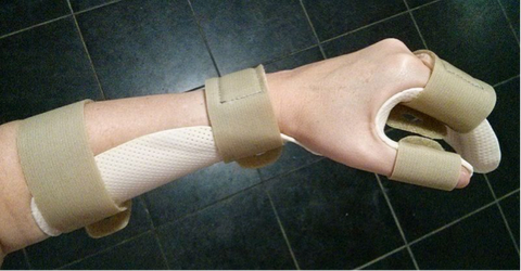 Hand Splint by Emmat Davis (unmodified)