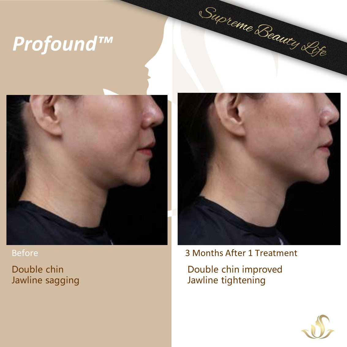 Profound Face/Neck – Supreme Beauty Life