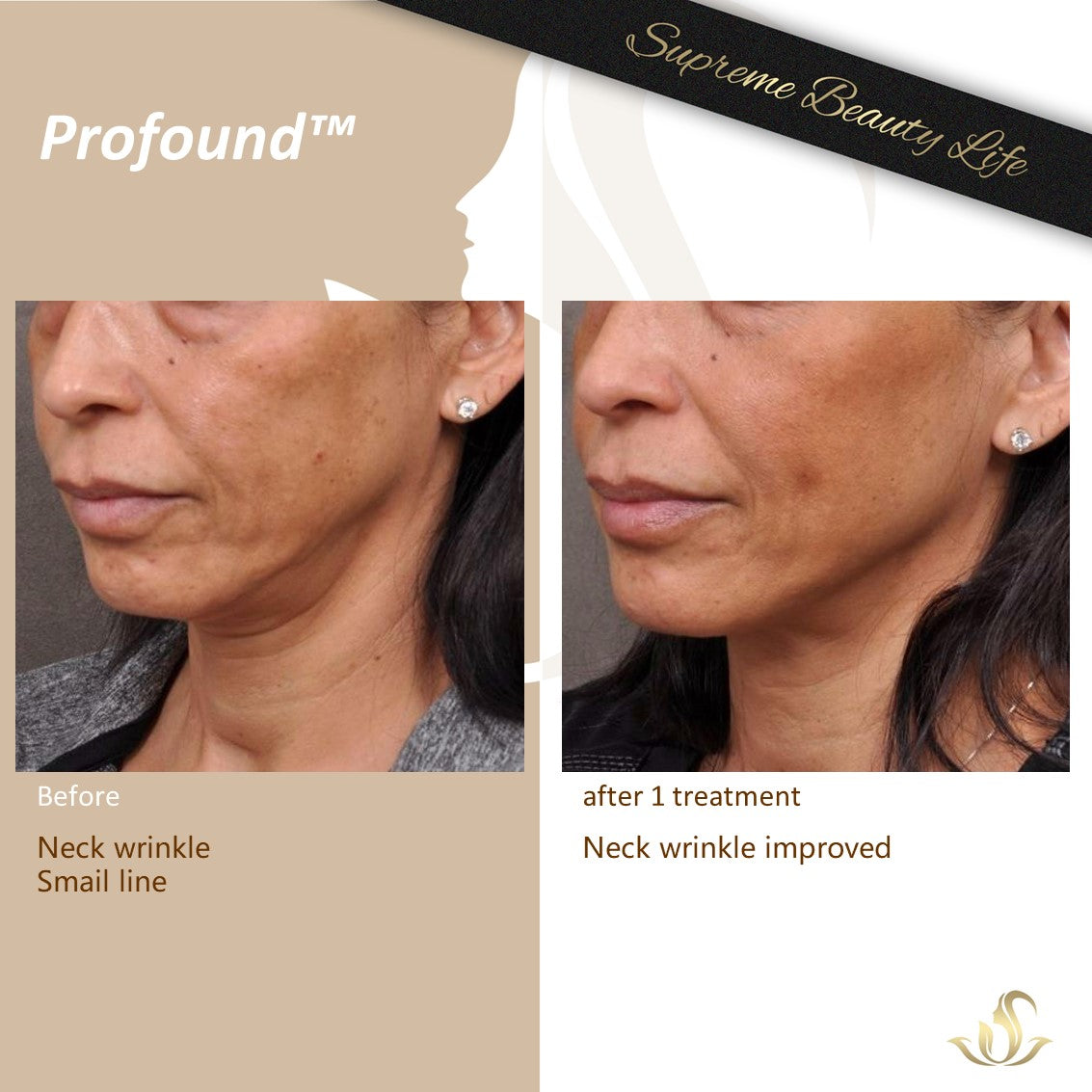 Profound Face/Neck – Supreme Beauty Life