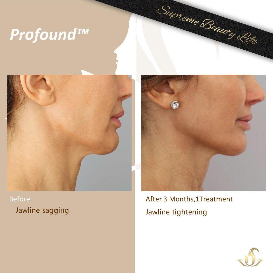 Profound Face/Neck – Supreme Beauty Life