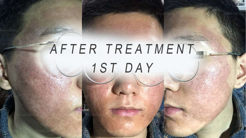 co2 fractional laser treatment