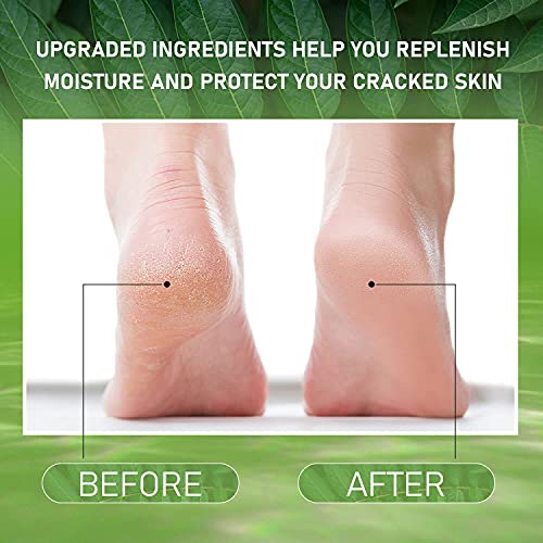 Vebuni Urea Cream 42% Foot Cream Salicylic Acid 4 Oz, Upgraded Callus Remover For Feet, Knees& Elbows, Intensive Moisturizes & Softens Skin, Exfoliates Dead Skin