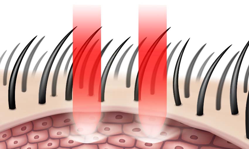 red light therapy stimulate hair follicle for hair regrowth