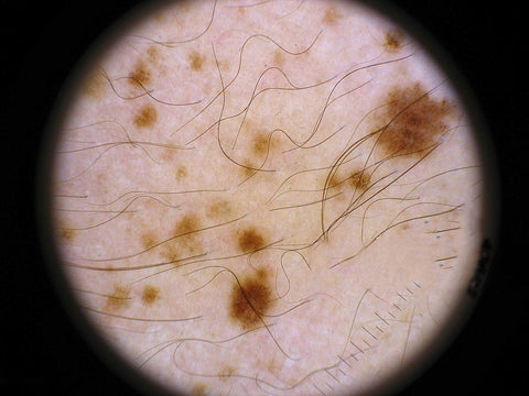 Efeito fotográfico do Dermatoscópio IBOOLO