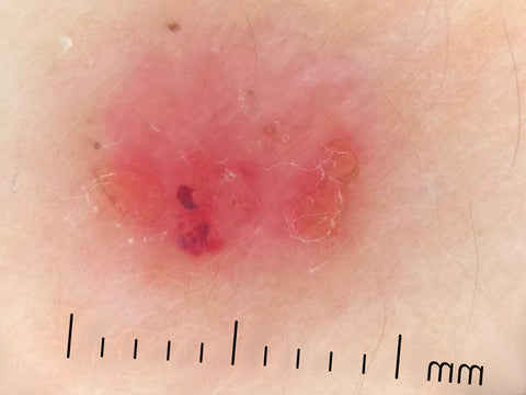 IBOOLO DE-400 ДЕРМАТОСКОП ЭФФЕКТ