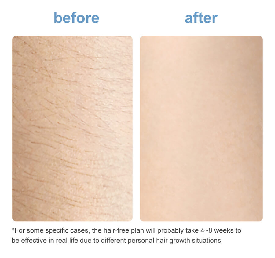 INFACE hair removal device ZH-18E - KKJ