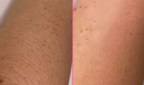 IGOODSKIN IPL HAIR REMOVEL