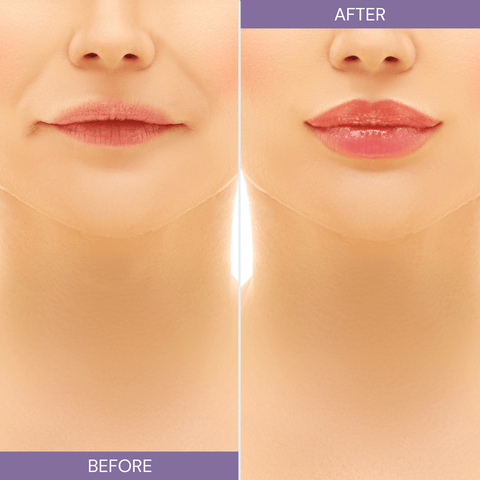 before and after lips filler