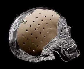 PEEK medical implants
