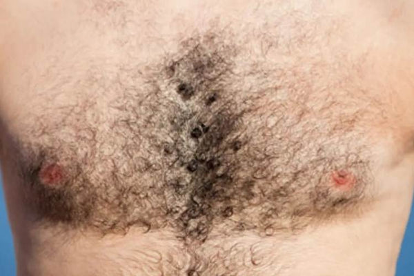 Understanding Manly Chest Hair Patterns