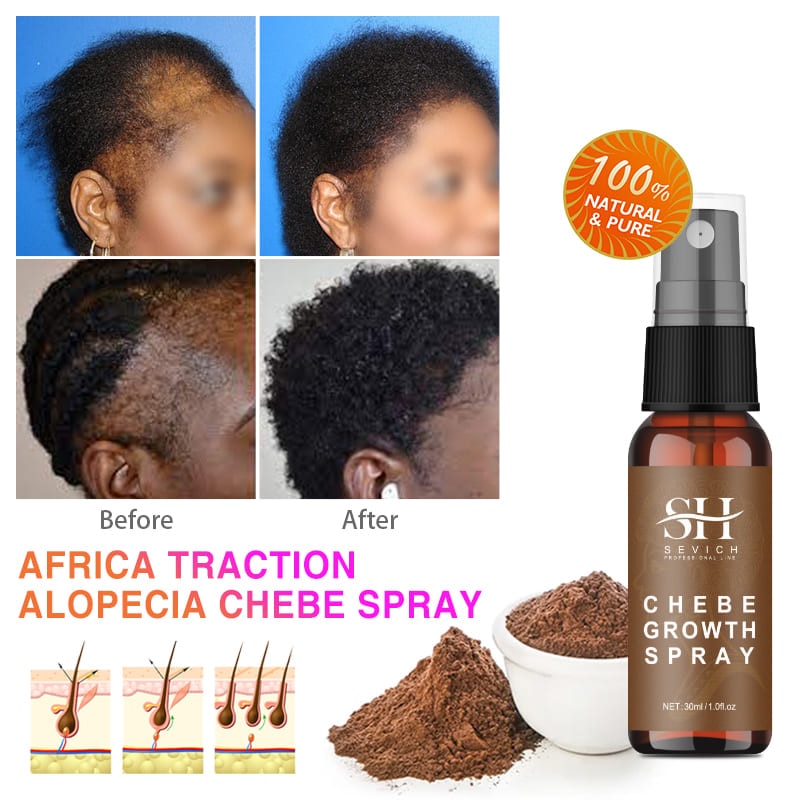Alopecia Treatment Oil Hair Growth Spray Hair Loss Treatment