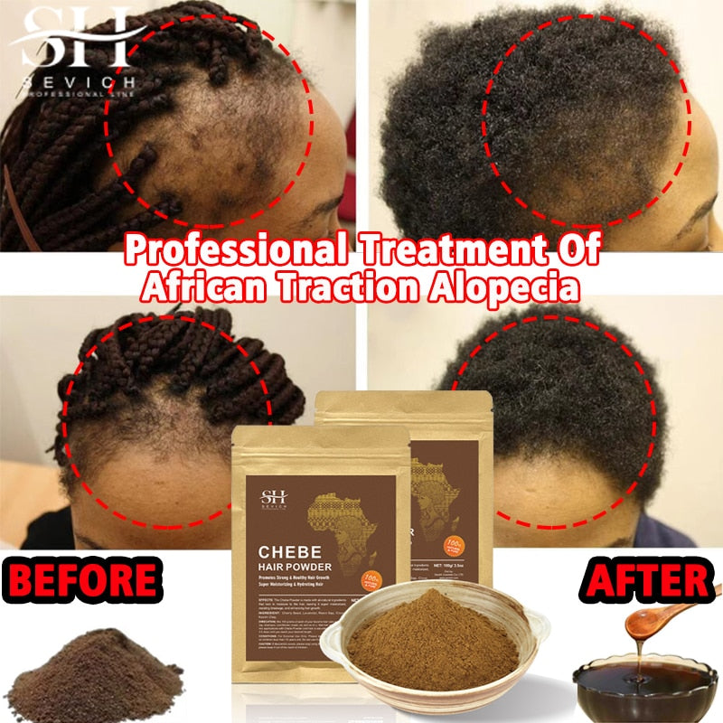 Alopecia Treatment Oil Hair Growth Spray Hair Loss Treatment