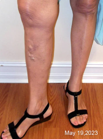 PureGlow™ Varicose Veins Treatment Spray