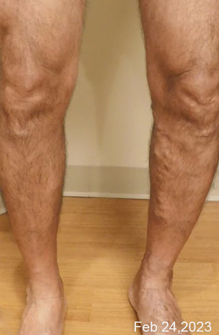 PureGlow™ Varicose Veins Treatment Spray