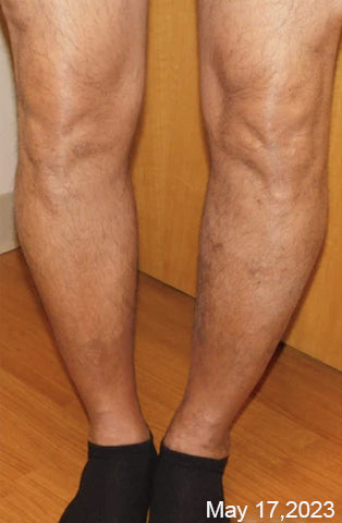 PureGlow™ Varicose Veins Treatment Spray