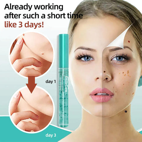 SmileCare™ Tag & Moles Remover