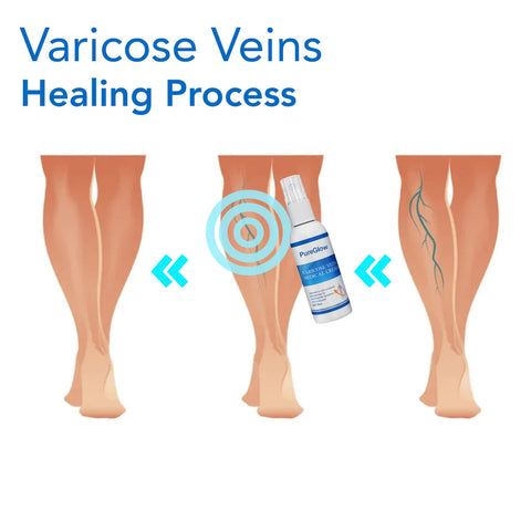 PureGlow™ Varicose Veins Treatment Spray