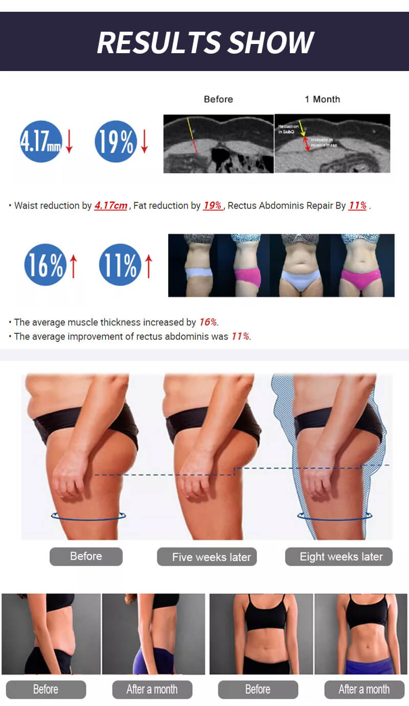 Efecto del tratamiento Emslim nova antes y después