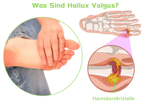 Biancat™ Hallux Valgus Entlastungspflaster