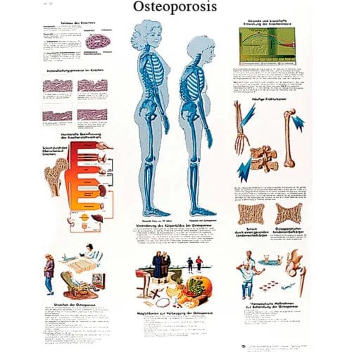 Anatomical Chart - Osteoporosis, Laminated