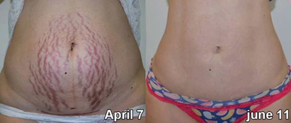 ๐๐๐ข๐๐ฅ๐จ๐ฎ๐ยฎ Fat Burning Ice Silk Ionic Fiber Shaping Shorts