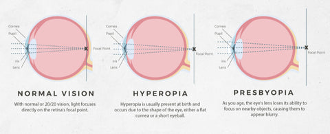 The Difference between Presbyopia and Hyperopia