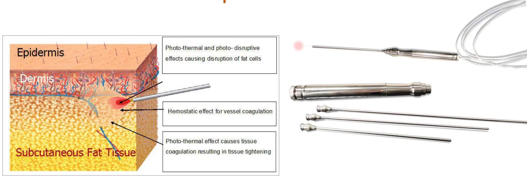 1470nm liposuction laser