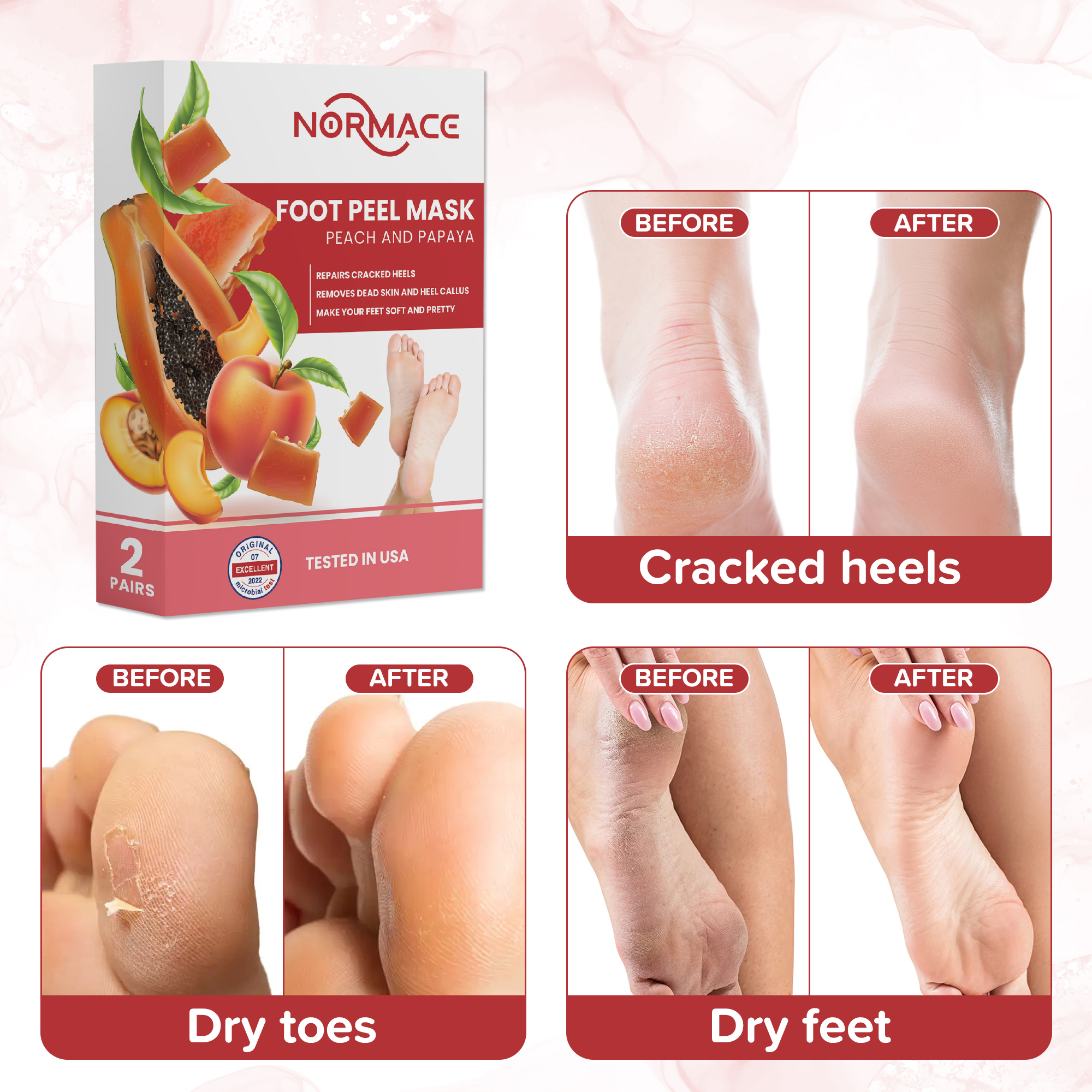 Foot Peel Mask with Peach and Papaya by Normace- 2 Pairs Exfoliating Foot Mask Microbial Tested for Dry, Cracked Feet, Callus & removing dead dry skin for soft baby feet.