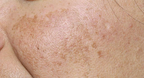 Melasma Chloasma