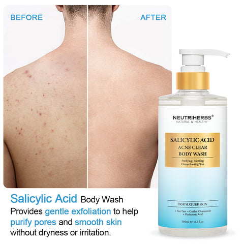 Comprender los diferentes tipos de acné corporal y cómo puede ayudar el ácido salicílico